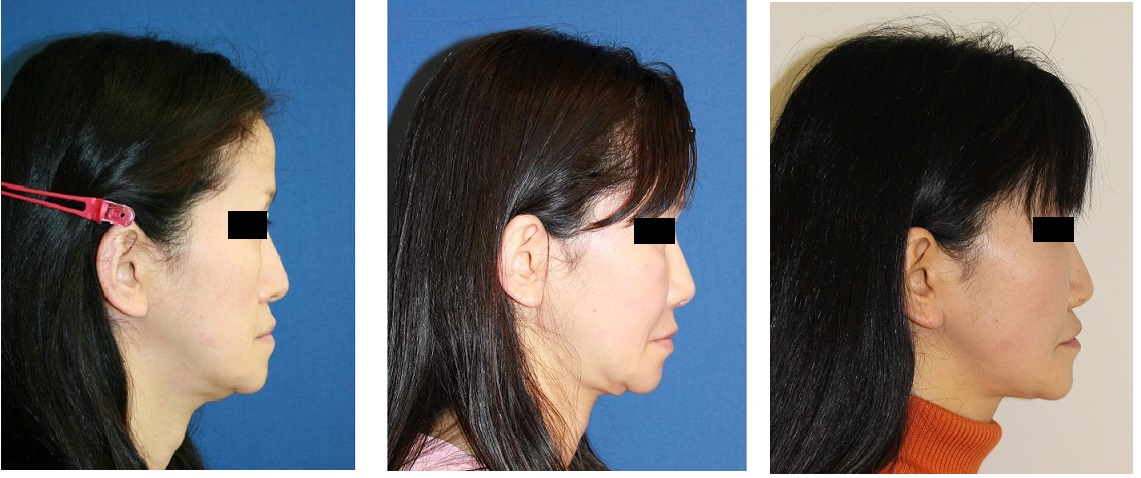 他院下顎縁スティック骨切り術後　：ミッドフェイスリフト、鼻翼基部プロテーゼ、　FAMI法等術後4年半_d0092965_4213728.jpg
