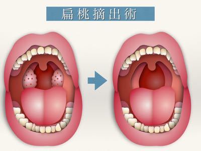 膿栓の取り方