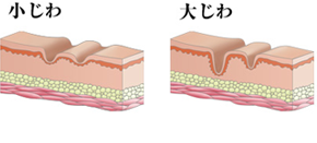 シワ・たるみの原因と治療_f0215297_20552115.png