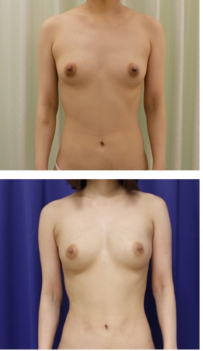 脂肪移植豊胸　術後約１年１０か月_d0092965_2321347.jpg