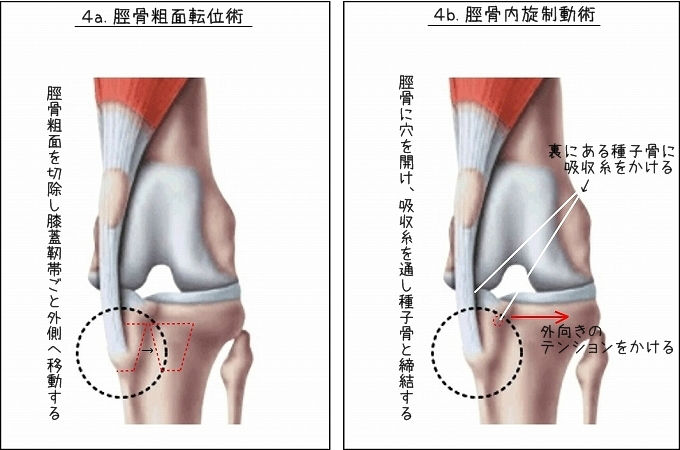 膝蓋骨脱臼 手術について こなつとじぃじ 膝蓋骨脱臼 手術について こなつとじぃじ