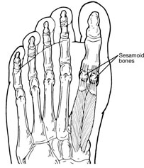 知らなかった！Sesamoid Subluxation in a Foot。_b0112009_23401672.png