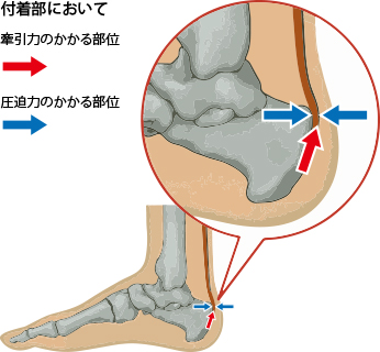 アキレス腱 痛風