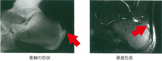足の痛み～2アキレス腱付着部症 診断～_a0296269_10005540.png