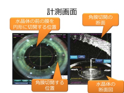 レーザー白内障手術_a0122285_21485824.jpg