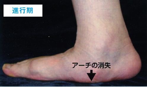 足の痛み~3 成人期扁平足~_a0296269_09300801.jpg