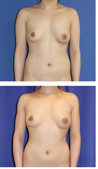 乳房左右差　是正　　：　右乳房脂肪移植、　左乳輪処置_d0092965_3383197.jpg