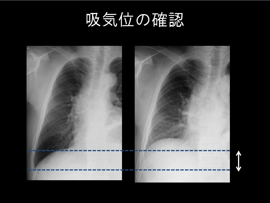 確認問題 胸部X線写真その1 : ピクトグラムでわかる呼吸器内科