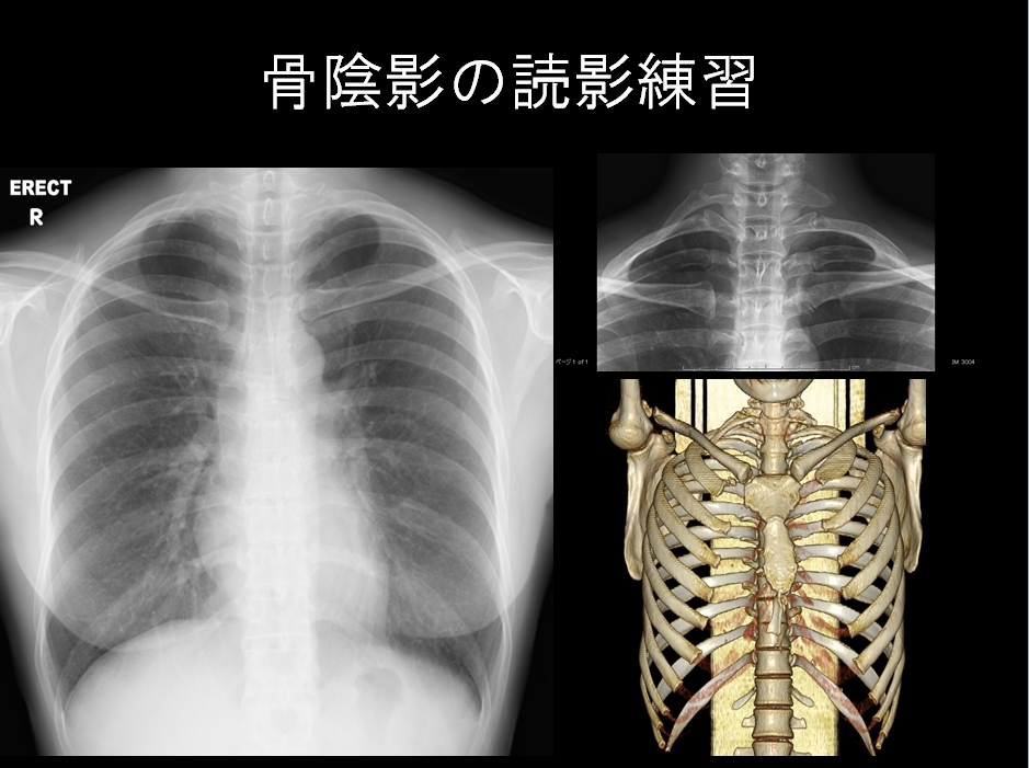 確認問題 胸部X線写真その1 : ピクトグラムでわかる呼吸器内科 確認問題 胸部X線写真その1 : ピクトグラムでわかる呼吸器内科