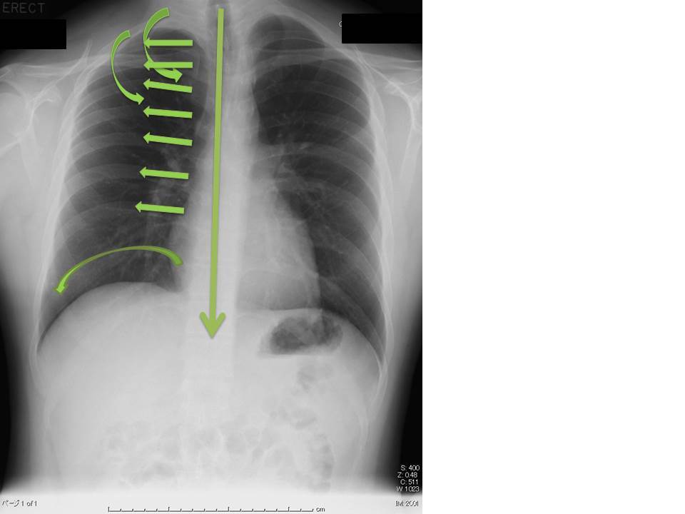 胸部X線写真 その1_c0367011_09590223.jpg