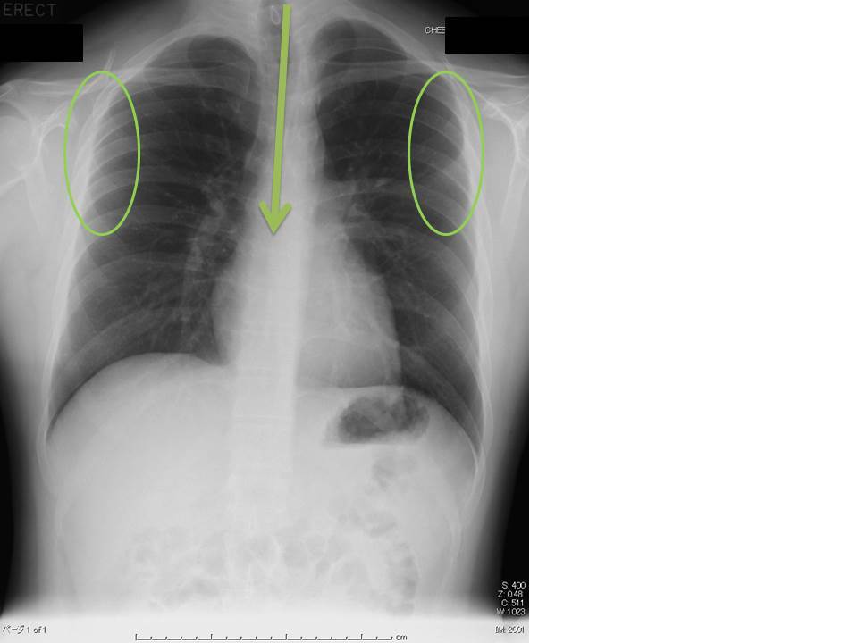 胸部X線写真 その1 : ピクトグラムでわかる呼吸器内科