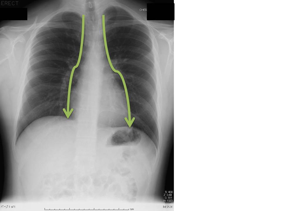 胸部X線写真 その1_c0367011_10005429.jpg