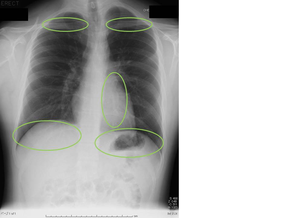 胸部X線写真 その1_c0367011_10011926.jpg