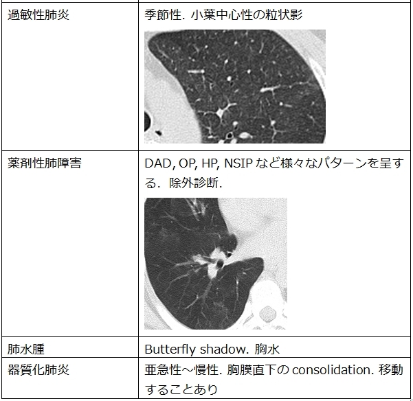 胸部CT　すりガラス影の鑑別_c0367011_14283033.jpg