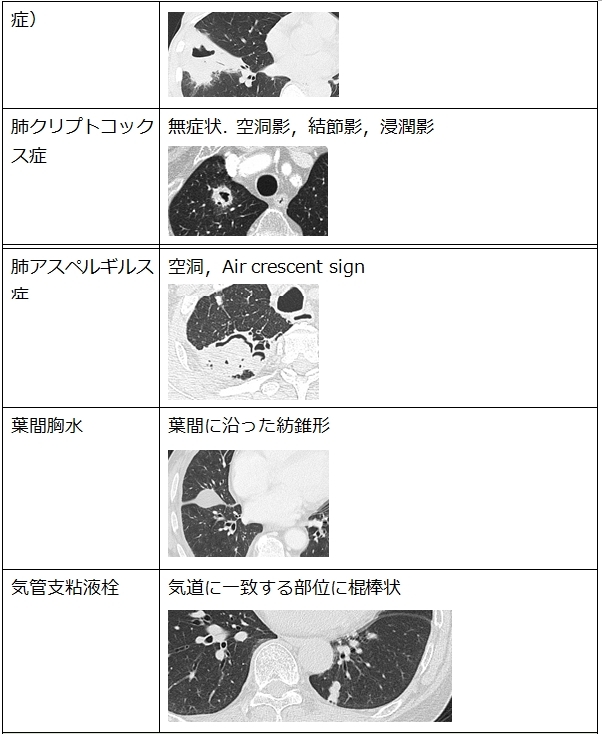 胸部ct 単発結節影の鑑別 ピクトグラムでわかる呼吸器内科 胸部ct 単発結節影の鑑別 ピクトグラムでわかる呼吸器内科