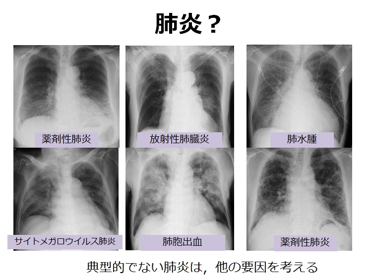 市中肺炎 初期治療 ピクトグラムでわかる呼吸器内科