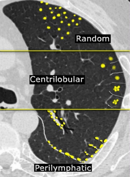 HRCT： High Resolution Computed Tomography　網状影・結節影_c0367011_23410999.jpg