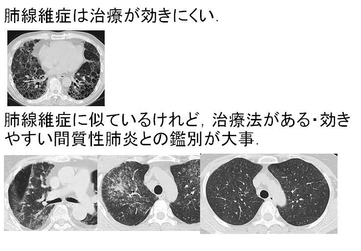 治る 肺炎 質 間 性