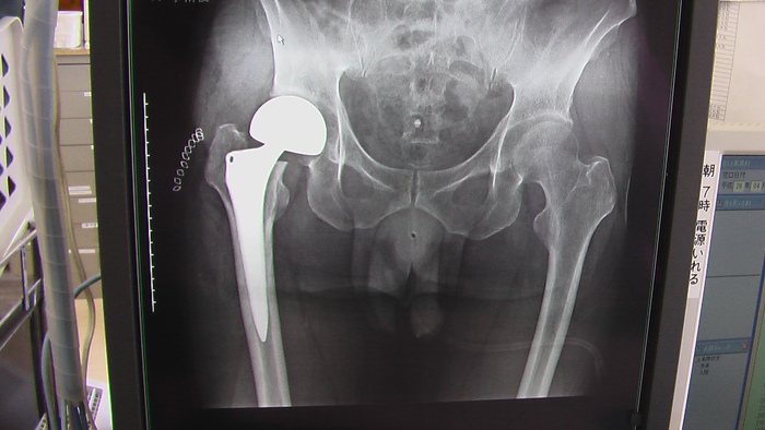 大腿骨頭置換術から一年_b0208961_10503950.jpg