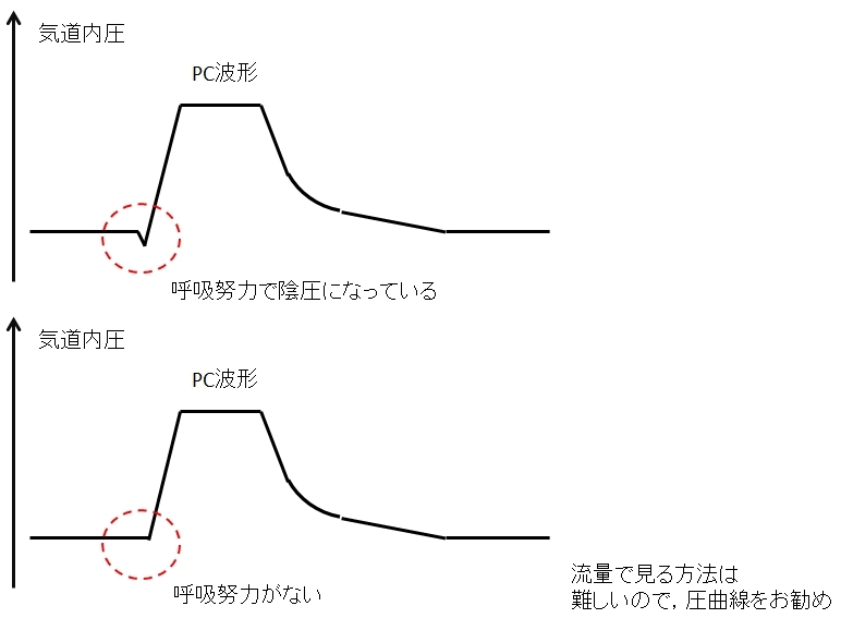 人工呼吸器のモード 自発呼吸の検出 トリガー ピクトグラムでわかる呼吸器内科