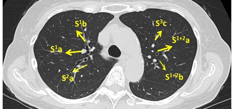 気管支鏡検査bronchoscope 検査前 ピクトグラムでわかる呼吸器内科 気管支鏡検査bronchoscope 検査前 ピクトグラムでわかる呼吸器内科