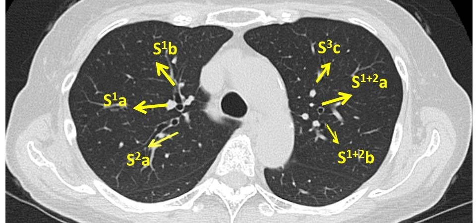 気管支鏡検査Bronchoscope　検査前_c0367011_20284594.jpg