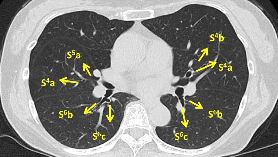 気管支鏡検査Bronchoscope　検査前_c0367011_20284908.jpg