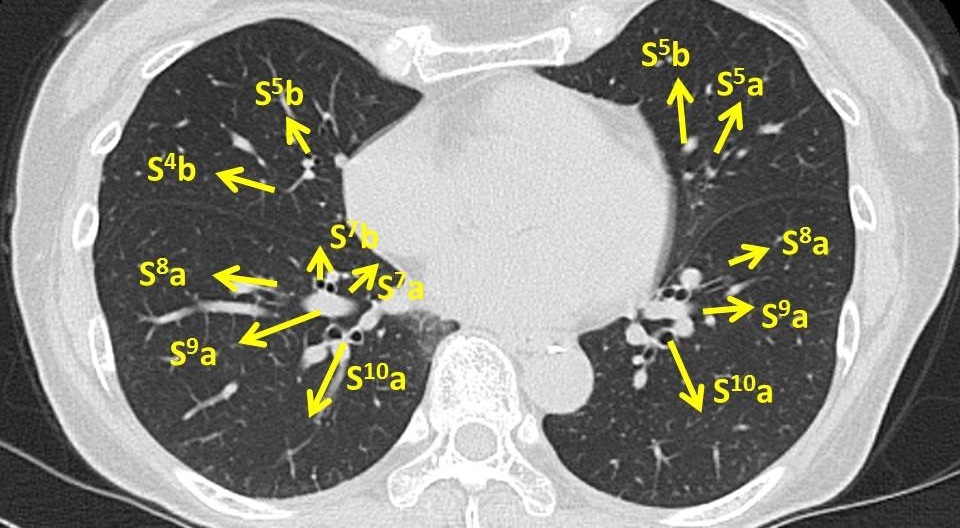 気管支鏡検査Bronchoscope　検査前_c0367011_20285135.jpg