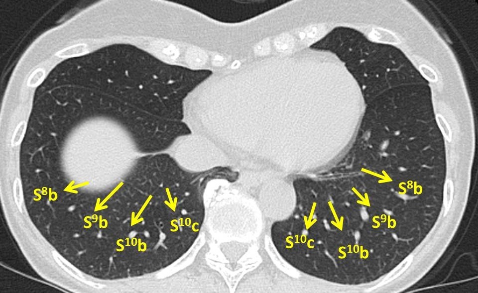 気管支鏡検査Bronchoscope　検査前_c0367011_20285217.jpg