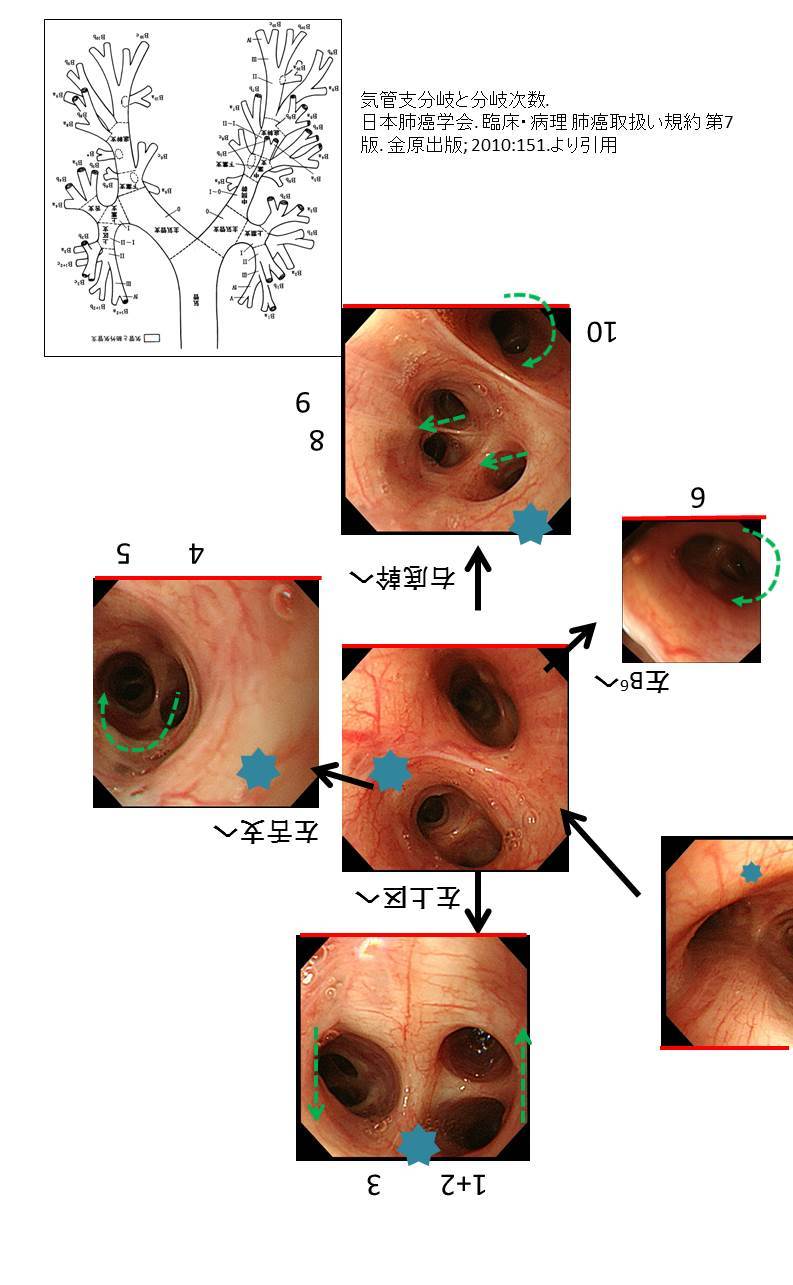 気管支鏡　観察_c0367011_20315072.jpg