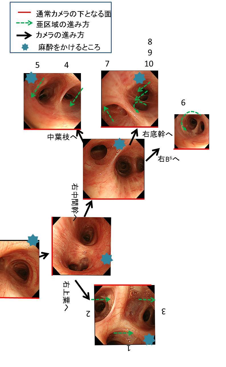 気管支鏡　観察_c0367011_20315331.jpg