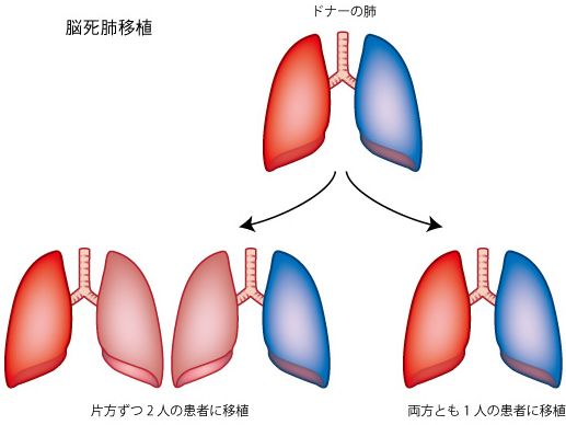 肺移植_c0367011_22165195.jpg