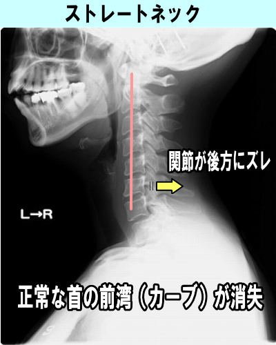 ダンサーも姿勢矯正に通う　伊丹市カイロプラクティック院。_a0201941_17333639.png