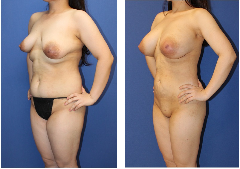 複数回　脂肪移植豊胸　　　最終施術より約1か月_d0092965_23543350.jpg