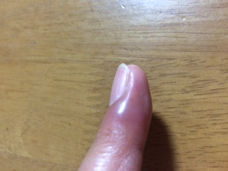 キズ口も 棘も刺さってないのに 泣 マダムの華麗なる生活 キズ口も 棘も刺さってないのに 泣 マダムの華麗なる生活