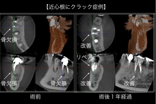 世界最高クラス画質CBCTの歯内療法、歯周治療の結果。 : 【イリタニオフィス】東京職人歯医者の神経を、歯を抜かなかった100症例+@ For DENTIST 世界最高クラス画質CBCTの歯内療法、歯周治療の結果。 : 【イリタニオフィス】東京職人歯医者の神経を、歯を抜かなかった100症例+@ For DENTIST