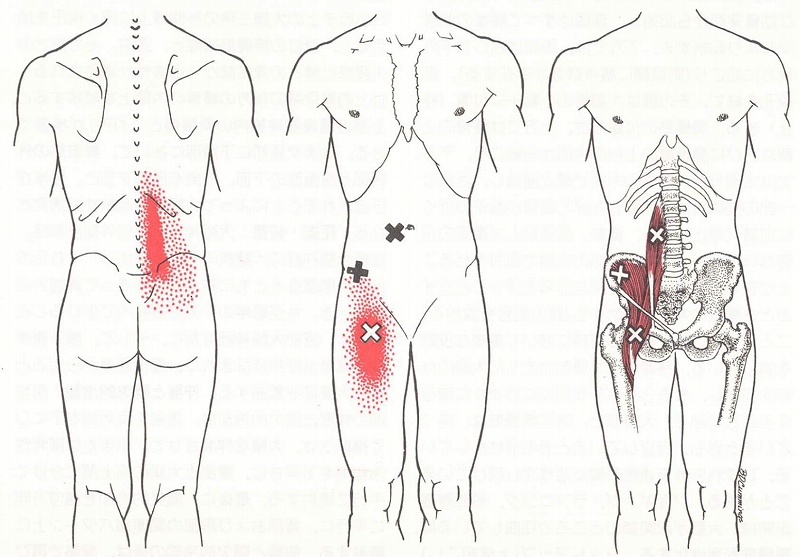 腸腰筋－トリガーポイントによる腰痛/鼠蹊部の痛み_f0121296_17475473.jpg