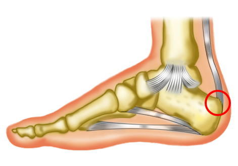 の が 足 痛い かかと 足底腱膜炎（足の裏・かかとの痛み）の治し方