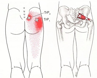 梨状筋－トリガーポイントによる殿部痛/坐骨神経痛_f0121296_12114931.jpg