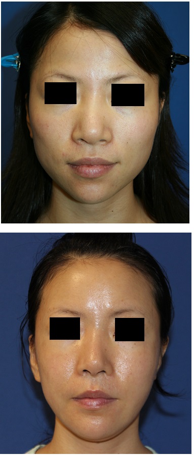 頬骨アーチリダクション、鼻根縮小術、小鼻縮小術、顎プロテーゼ_d0092965_3193760.jpg