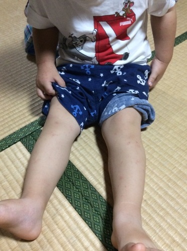 手足口病と1歳8カ月検診_c0362580_15052631.jpg