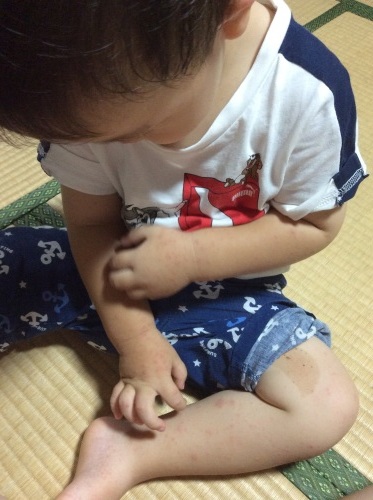 手足口病と1歳8カ月検診_c0362580_15053921.jpg
