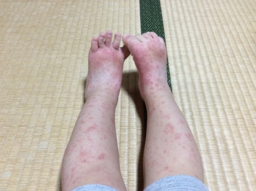 手足口病と1歳8カ月検診_c0362580_15055720.jpg
