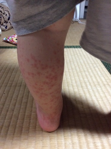 手足口病と1歳8カ月検診_c0362580_15061493.jpg