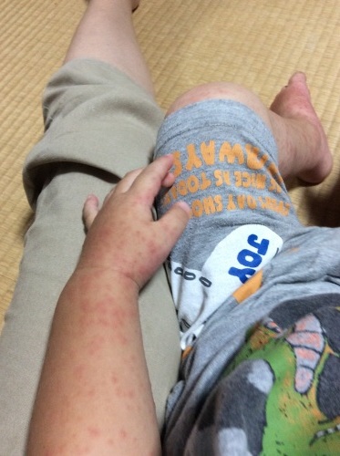 手足口病と1歳8カ月検診_c0362580_15170699.jpg