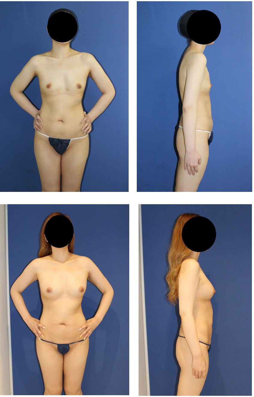 脂肪移植豊胸　一年に三回　最終施術より術後3か月_d0092965_0115465.jpg