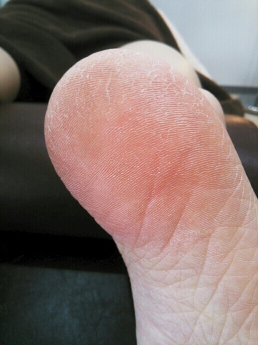 本日の角質ケアの患者さま_e0334332_17160481.jpg