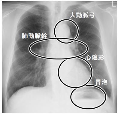 胸部レントゲン写真をどのように説明するか_e0156318_23552710.jpg