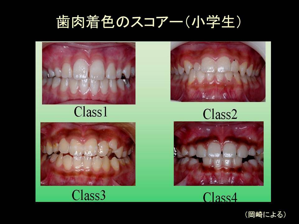 喫煙者は歯周病の自覚症状が無い_f0197703_15484482.jpg