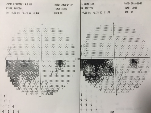 正常眼圧緑内障は視神経乳頭を生薬で治療すれば治る_b0200019_22281684.jpg
